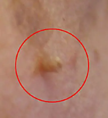 Skin tag close up