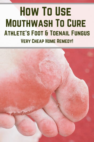 Mouthwash to cure athlete's foot home remedy