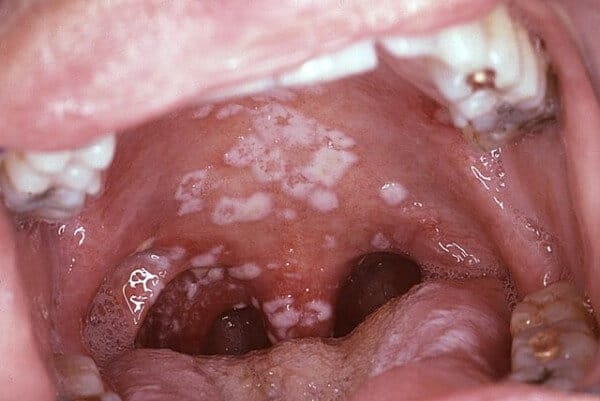 Candidiasis - yeast infection of the mouth