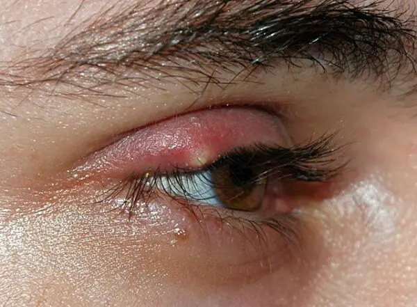 Close up of a stye - 11 home remedies for styes