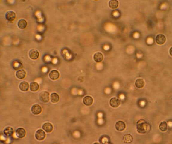 white cells in urine indicate UTI infection