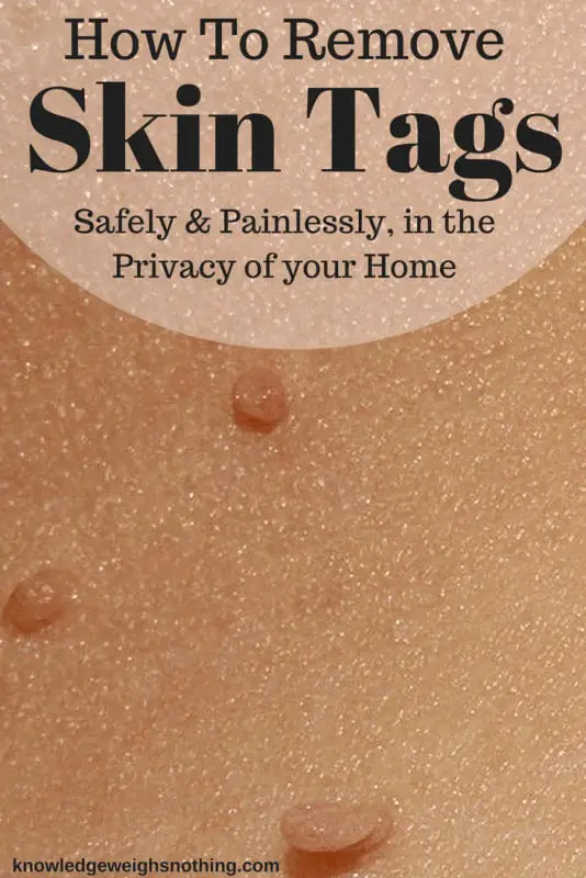 How To Remove Skin Tags At Home Tagband And Home Remedies