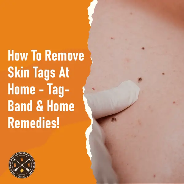 How To Remove Skin Tags At Home