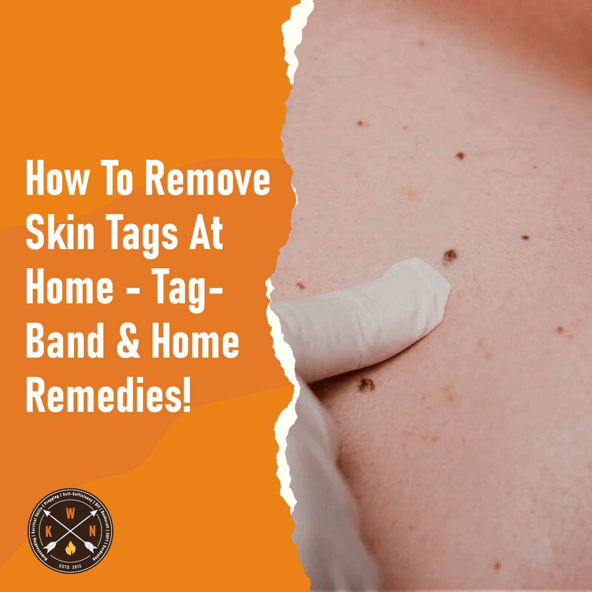 How To Remove Skin Tags At Home TagBand & Home Remedies!